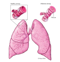 Astma Disease 