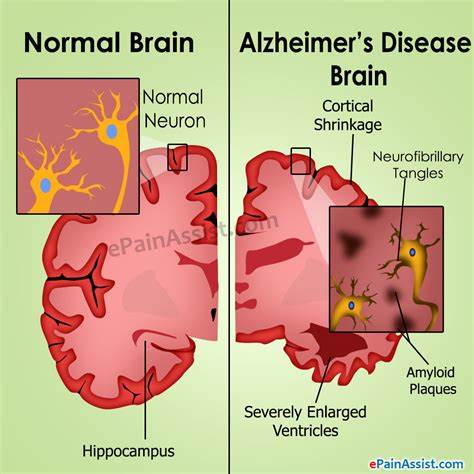 Alzheimer brain and normal brain