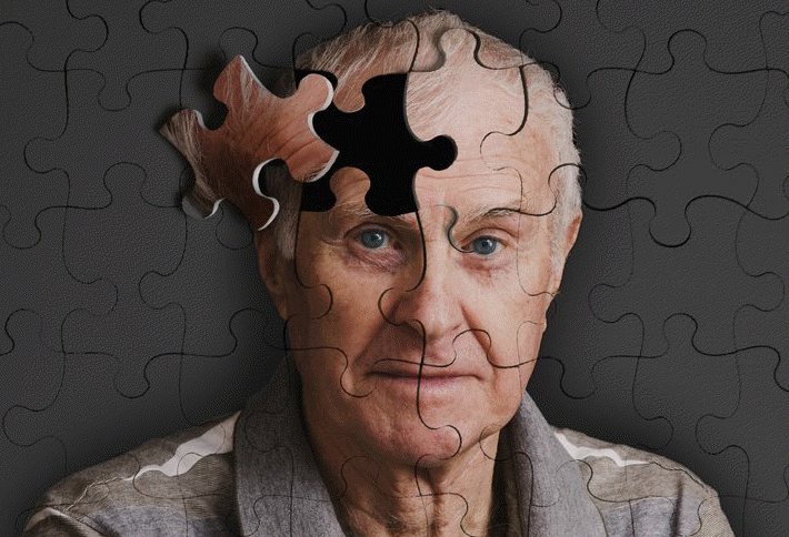Alzheimer Disease 