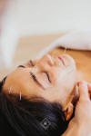 intro acupuncture