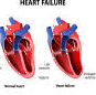 Congestive Heart Failure