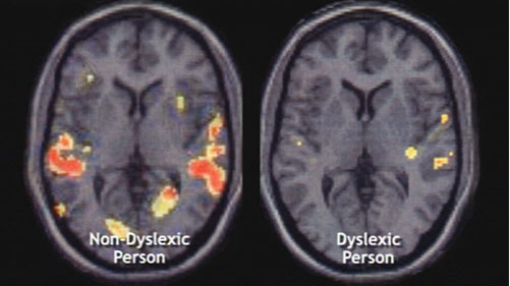 Non-Dyslexic Brain vs. Dyslexic Brain