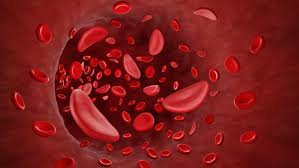 Sickle Cell Blood Cells