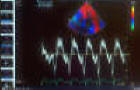 Echocardiograms