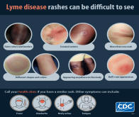 Symptoms