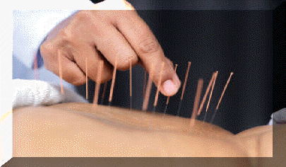 Acupuncture needles on a persons back