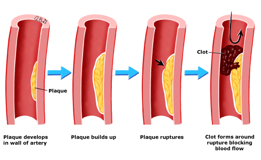 PlaqueformationPI