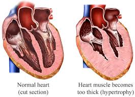 Two hearts describing the difference for hypothermia