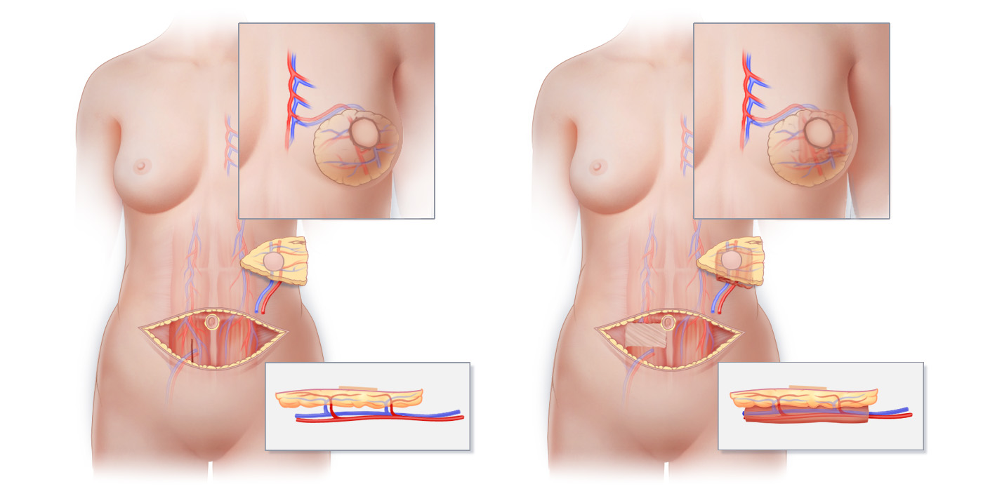 Types of Plastic Surgery Overview