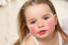 Girl with face allergy