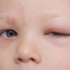Boy with eye allergy